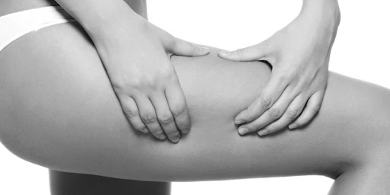 cellulite reduction at Chicago Body Sculpting 